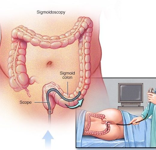 Cách điều trị bệnh ung thư đại tràng